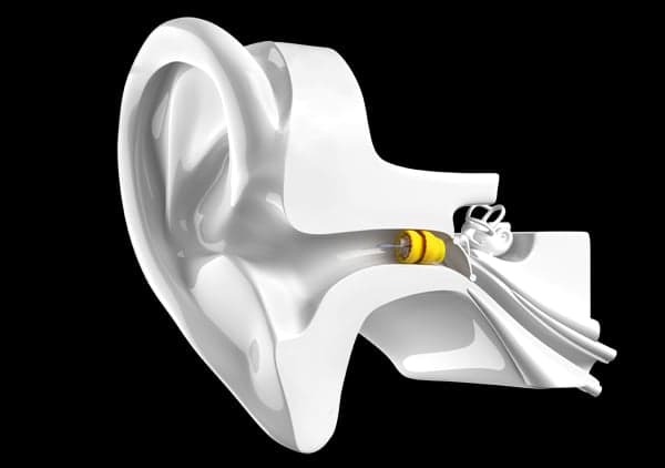 Phonak Lyric in Ear