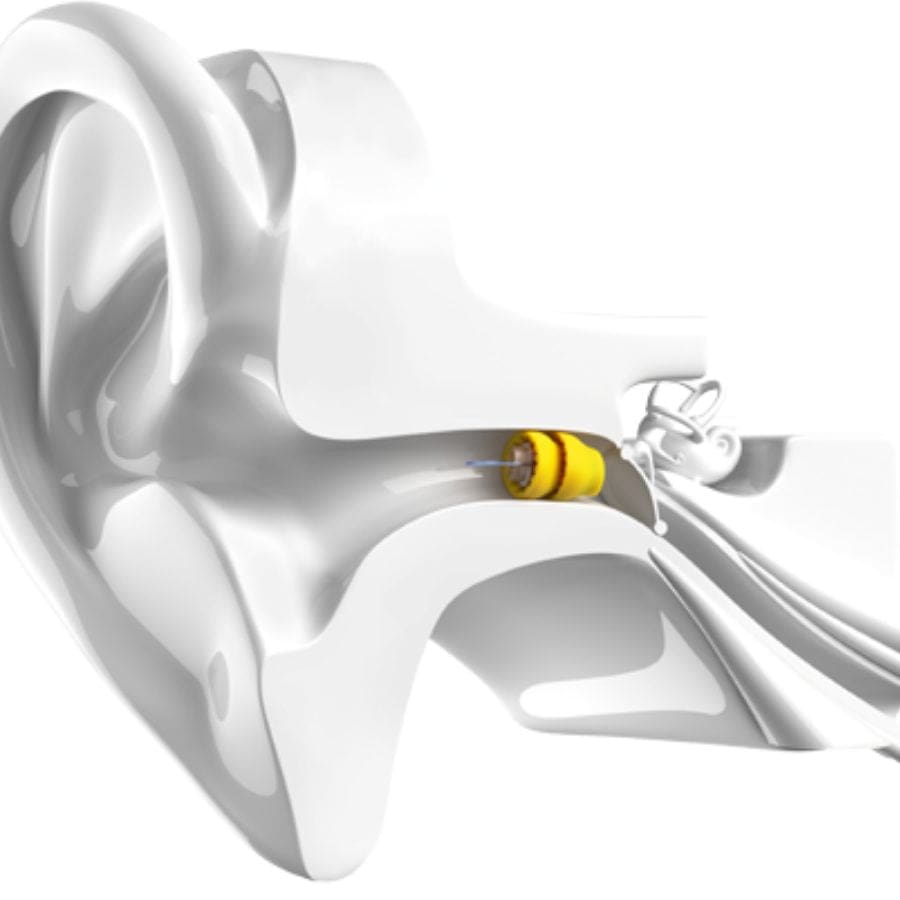 The Luyric Hearing aid is placed deep in the ear canal by our staff, and no one can see it.